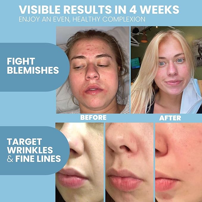 Retinol Serum for Face with Hyaluronic Acid – Anti Aging Skin Care for Fine Lines, Wrinkles, Dark Spots & Blemish – Brightening Resurfacing Serum for Post Acne and Sensitive Skin – 2oz
